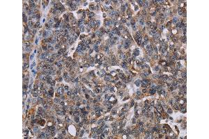 Immunohistochemistry of Human ovarian cancer using LDOC1 Polyclonal Antibody at dilution of 1:50