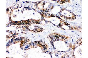 Anti-NKCC1 antibody, IHC(P) IHC(P): Human Intestinal Cancer Tissue