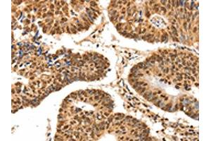 The image on the left is immunohistochemistry of paraffin-embedded Human colon cancer tissue using ABIN7192626(SPATA20 Antibody) at dilution 1/70, on the right is treated with synthetic peptide. (SPATA2 Antikörper)