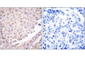 Immunohistochemistry analysis of paraffin-embedded human lung carcinoma tissue, using Cullin 1 Antibody. (Cullin 1 Antikörper  (AA 727-776))