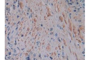 IHC-P analysis of Human Prostate cancer Tissue, with DAB staining. (FTL Antikörper  (AA 2-175))