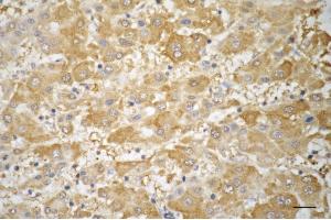 Immunohistochemistry was performed on paraffin-embedded human hepatocarcinoma using TRIM7 antibody (ABIN7800643), 1:200). (TRIM7 Antikörper)