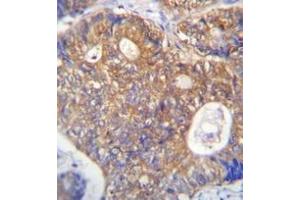 Immunohistochemistry analysis in formalin fixed and paraffin embedded human colon carcinoma reacted with PAICS Antibody (N-term) followed which was peroxidase conjugated to the secondary antibody and followed by DAB staining. (PAICS Antikörper  (N-Term))
