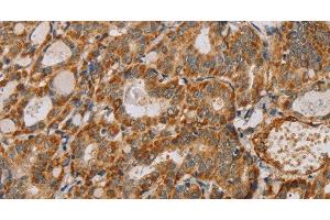 Immunohistochemistry of paraffin-embedded Human thyroid cancer using MTFR1 Polyclonal Antibody at dilution of 1:40 (MTFR1 Antikörper)