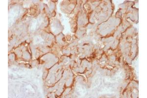 Formalin-fixed, paraffin-embedded human Ovarian Carcinoma stained with MUC16 Rabbit Recombinant Monoclonal Antibody (OCA125/2349R).