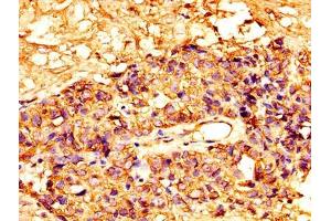 IHC image of ABIN7159428 diluted at 1:300 and staining in paraffin-embedded human ovarian cancer performed on a Leica BondTM system. (Mesothelin Antikörper  (AA 37-598))