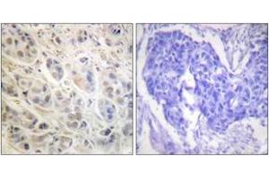 Immunohistochemistry analysis of paraffin-embedded human breast carcinoma tissue, using p90 RSK (Ab-573) Antibody. (RPS6KA3 Antikörper  (AA 539-588))