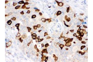 Anti- RRM2 Picoband antibody, IHC(P) IHC(P): Human Mammary Cancer Tissue (RRM2 Antikörper  (N-Term))