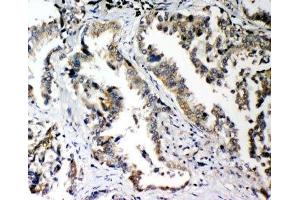 IHC-P: PLK2 antibody testing of human lung cancer tissue