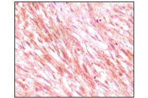 Immunohistochemical analysis of paraffin-embedded maligant mesenchymoma tissues, showing cytoplasmic localization using C-kit mouse mAb with DAB staining. (KIT Antikörper)