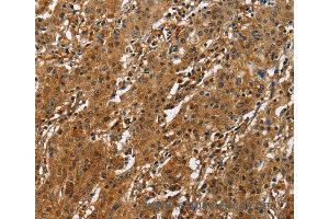 Immunohistochemistry of Human liver cancer using ATF4 Polyclonal Antibody at dilution of 1:50 (ATF4 Antikörper)