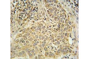 AHR antibody immunohistochemistry analysis in formalin fixed and paraffin embedded human lung carcinoma. (Aryl Hydrocarbon Receptor Antikörper  (AA 555-582))