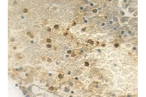 ABIN6259186 and ABIN6275604 at 1/100 staining human pituitary adenoma by IHC-P. (SF3B4 Antikörper  (N-Term))