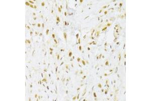 Immunohistochemistry of paraffin-embedded human gastric cancer using RBPJ Antibody (ABIN1876876) at dilution of 1:100 (40x lens). (RBPJ Antikörper)