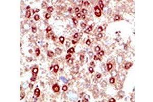 IHC testing of human hepatocarcinoma stained with SUMO2/3 antibody. (SUMO2/3 Antikörper  (AA 49-81))