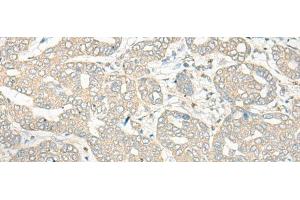 Immunohistochemistry of paraffin-embedded Human liver cancer tissue using HLA-DRB5 Polyclonal Antibody at dilution of 1:45(x200)