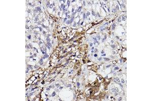 Immunohistochemistry of paraffin-embedded human lung cancer using GBP1 Rabbit mAb (ABIN7267549) at dilution of 1:100 (40x lens). (GBP1 Antikörper)