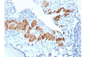 Formalin-fixed, paraffin-embedded human Breast Carcinoma stained with SM-MHC Recombinant Rabbit Monoclonal Antibody (MYH11/2303R). (Rekombinanter MYH11 Antikörper)