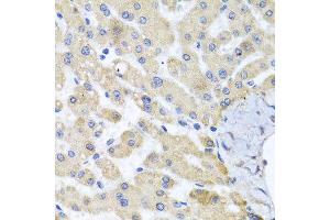Immunohistochemistry of paraffin-embedded human liver injury using ABCB8 antibody at dilution of 1:100 (x40 lens). (ABCB8 Antikörper)