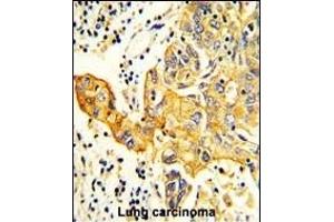 Formalin-fixed and paraffin-embedded human Lung carcinoma reacted with RARS2 Antibody (C-term), which was peroxidase-conjugated to the secondary antibody, followed by DAB staining.