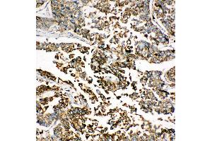 Anti-GRP78 BiP antibody, IHC(P) IHC(P): Human Lung Cancer Tissue (GRP78 Antikörper  (C-Term))