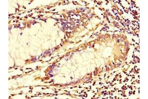 Immunohistochemistry of paraffin-embedded human colon cancer using ABIN7173699 at dilution of 1:100 (TUBG1 Antikörper  (AA 29-184))