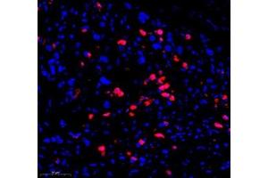 Immunofluorescence of paraffin embedded human gastric cancer using CD307 (ABIN7073931) at dilution of 1:1200 (300x lens)