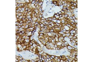 Immunohistochemistry of paraffin-embedded human mammary cancer using FCGR1B antibody (ABIN7267161) at dilution of 1:100 (40x lens). (FCGR1B Antikörper)