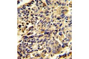 Immunohistochemistry analysis in formalin-fixed and paraffin-embedded human lung carcinoma reacted with Glypican-1 / GPC1Antibody (N-term) followed which was peroxidase-conjugated to the secondary antibody, followed by DAB staining. (GPC1 Antikörper  (N-Term))