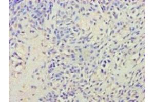 Immunohistochemistry of paraffin-embedded human breast cancer using ABIN7175416 at dilution of 1:100 (Vasopressin Antikörper  (AA 126-164))