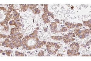 ABIN6272719 at 1/100 staining Human liver cancer tissue by IHC-P. (OR2B3 Antikörper  (Internal Region))