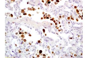 Formalin-fixed and paraffin embedded human lung carcinoma labeled with Anti-Granzyme B Polyclonal Antibody, Unconjugated (ABIN675354) at 1:200 followed by conjugation to the secondary antibody and DAB staining