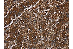 The image on the left is immunohistochemistry of paraffin-embedded Human liver cancer tissue using ABIN7191233(KLRF1 Antibody) at dilution 1/30, on the right is treated with synthetic peptide. (KLRF1 Antikörper)