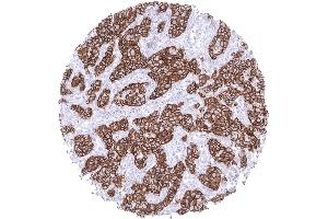 Immunohistochemistry (IHC) image for anti-Cadherin 1, Type 1, E-Cadherin (Epithelial) (CDH1) antibody (ABIN7477465)