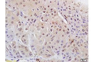 Formalin-fixed and paraffin embedded human laryngeal carcinoma labeled with Anti Phospho-cdc2 (Tyr15) Polyclonal Antibody, Unconjugated (ABIN684013) at 1:200 followed by conjugation to the secondary antibody and DAB staining (CDK1 Antikörper  (pTyr15))