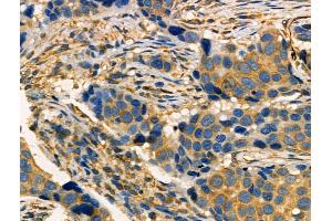 Phospho-MAP4K4 (Ser801) Antibody at 1/100 staining Human breast cancer by IHC-P. (MAP4K4 Antikörper  (pSer801))