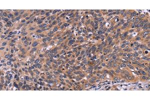Immunohistochemistry of paraffin-embedded Human cervical cancer tissue using SPATA7 Polyclonal Antibody at dilution 1:30 (SPATA7 Antikörper)