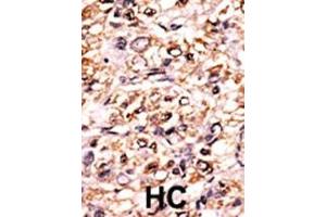 Formalin-fixed and paraffin-embedded human cancer tissue reacted with the primary antibody, which was peroxidase-conjugated to the secondary antibody, followed by DAB staining. (Separase Antikörper  (pSer1126))