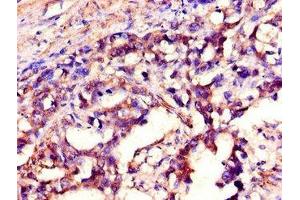 Immunohistochemistry of paraffin-embedded human gastric cancer using ABIN7169449 at dilution of 1:100