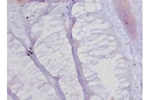 Immunohistochemistry of paraffin-embedded human colon cancer using ABIN7148231 at dilution of 1:20 (COL17A1 Antikörper  (AA 1253-1497))