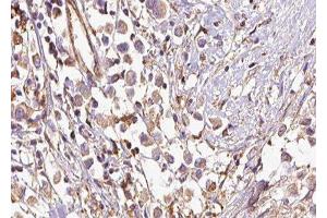 ABIN6277523 at 1/100 staining Human breast cancer tissue by IHC-P.