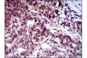 Immunohistochemical analysis of paraffin-embedded esophageal cancer tissues using CLGN mouse mAb with DAB staining. (Calmegin Antikörper  (AA 249-405))