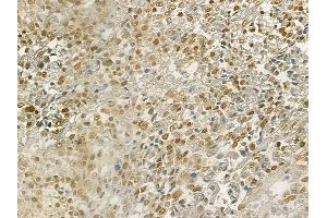 ABIN6265989 and ABIN6269137 at 1/100 staining human prostate carcinoma by IHC-P.