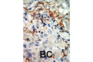 Formalin-fixed and paraffin-embedded human cancer tissue reacted with EPHA3 polyclonal antibody  , which was peroxidase-conjugated to the secondary antibody, followed by AEC staining. (EPH Receptor A3 Antikörper  (N-Term))
