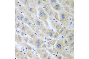 Immunohistochemistry of paraffin-embedded human liver cancer using BLVRB antibody. (BLVRB Antikörper  (AA 1-206))
