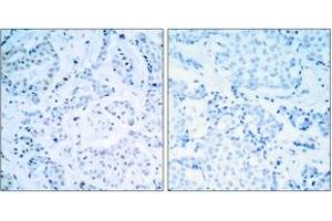 Immunohistochemistry analysis of paraffin-embedded human breast carcinoma tissue, using Estrogen Receptor-alpha (Ab-104) Antibody. (Estrogen Receptor alpha Antikörper  (AA 81-130))