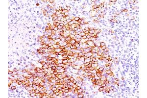 Formalin-fixed, paraffin-embedded human Hodgkin's lymphoma stained with CD30 Ab (CD30/412). (TNFRSF8 Antikörper)