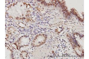 Immunoperoxidase of monoclonal antibody to PSME2 on formalin-fixed paraffin-embedded human stomach carcinoma. (PSME2 Antikörper  (AA 1-90))
