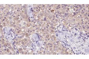 ABIN6273344 at 1/100 staining Human thyroid cancer tissue by IHC-P.