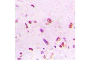 Immunohistochemical analysis of Ku70 staining in human lung cancer formalin fixed paraffin embedded tissue section. (XRCC6 Antikörper  (C-Term))